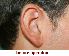 plastic-surgery-prominent-ear 